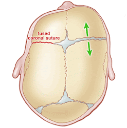 What is Coronal Craniosynostosis?