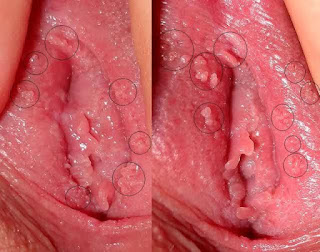 obat kutil kelamin wanita obat kutil kelamin wanita