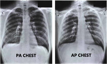 normal chest xray labeled