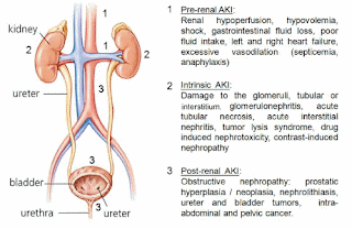 Acute Kidney Injury (AKI)