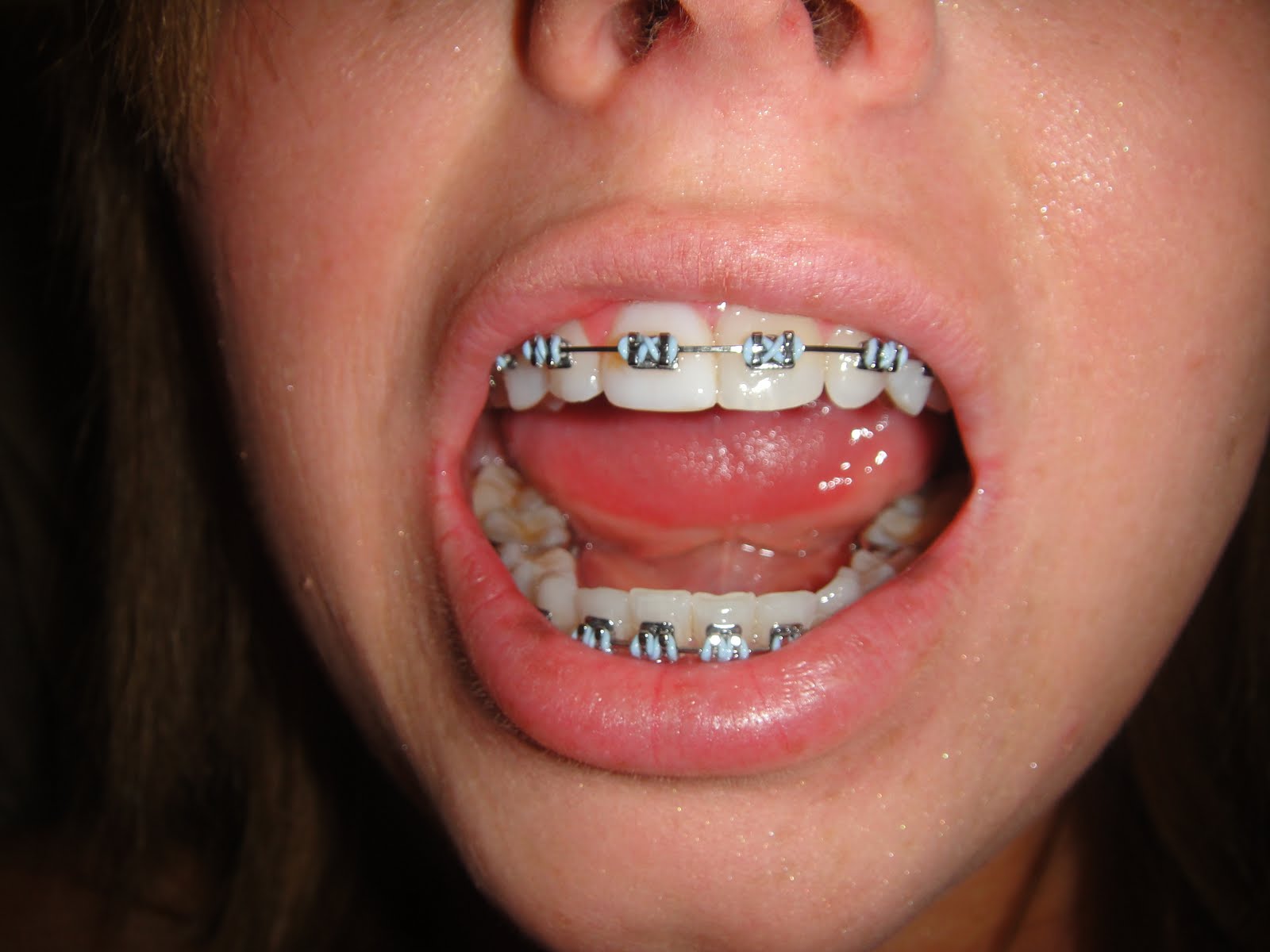 bad getting inward needs braces teeth tooth come ready them need whiten probably nov turn 1st last
