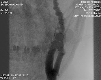 My carotid artery.. affected by FMD click this pic and then stories from the USA... my story..