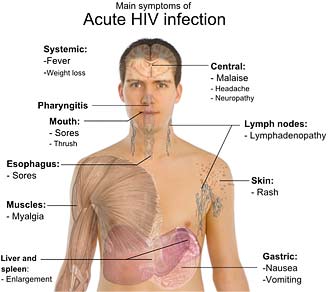 hiv symptoms swollen lymph nodes hiv