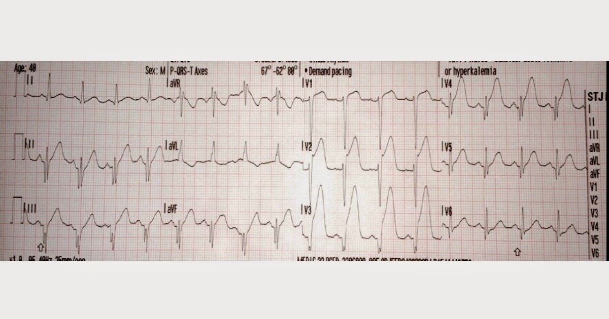ECGs for EMS Non Sustained VT Making a Lasting Impression!