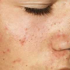 Schiuma per chiarificazione della persona