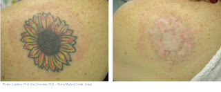 tattoo removal is really a very long and incredibly painful process so ...