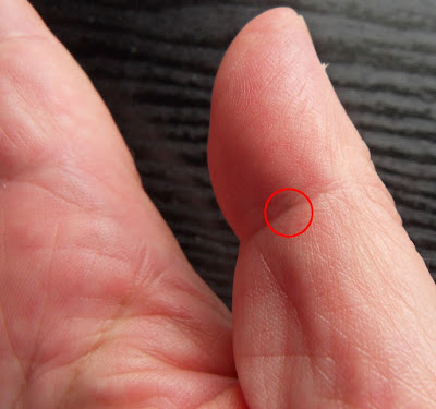 Alien implant in thumb