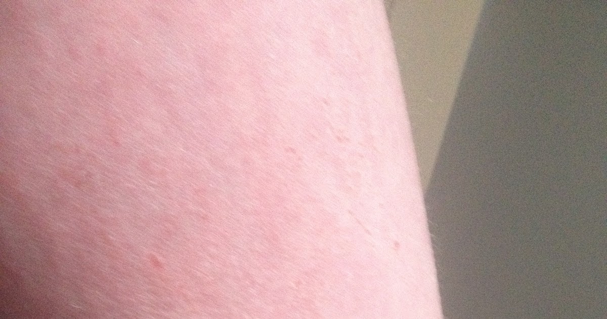 Healing Eczema and Cortisone Withdrawal Symptoms Network and Moving