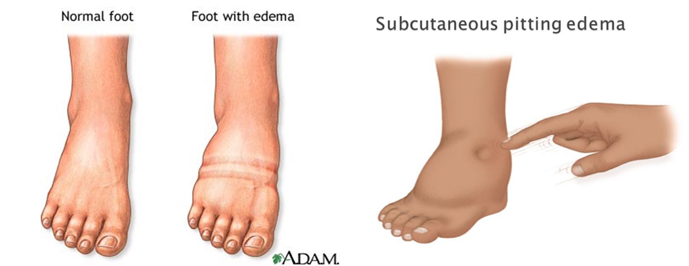 Swollen Ankles The Early Warning Sign Of A Life Threatening Condition - ki256ha