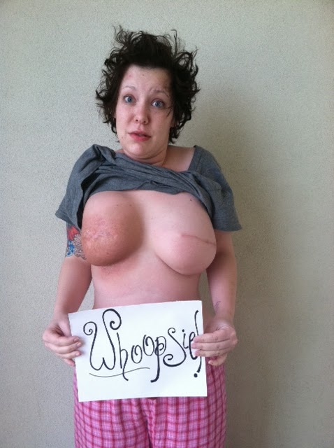 lopsided+boob.JPG