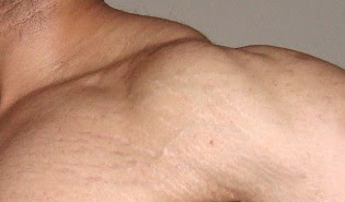 cara hilangkan stretch mark