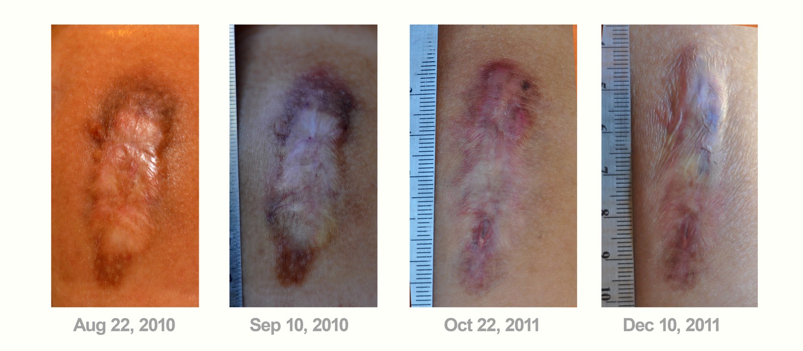 keloid diary keloid its growing keloid silicone gel sheets