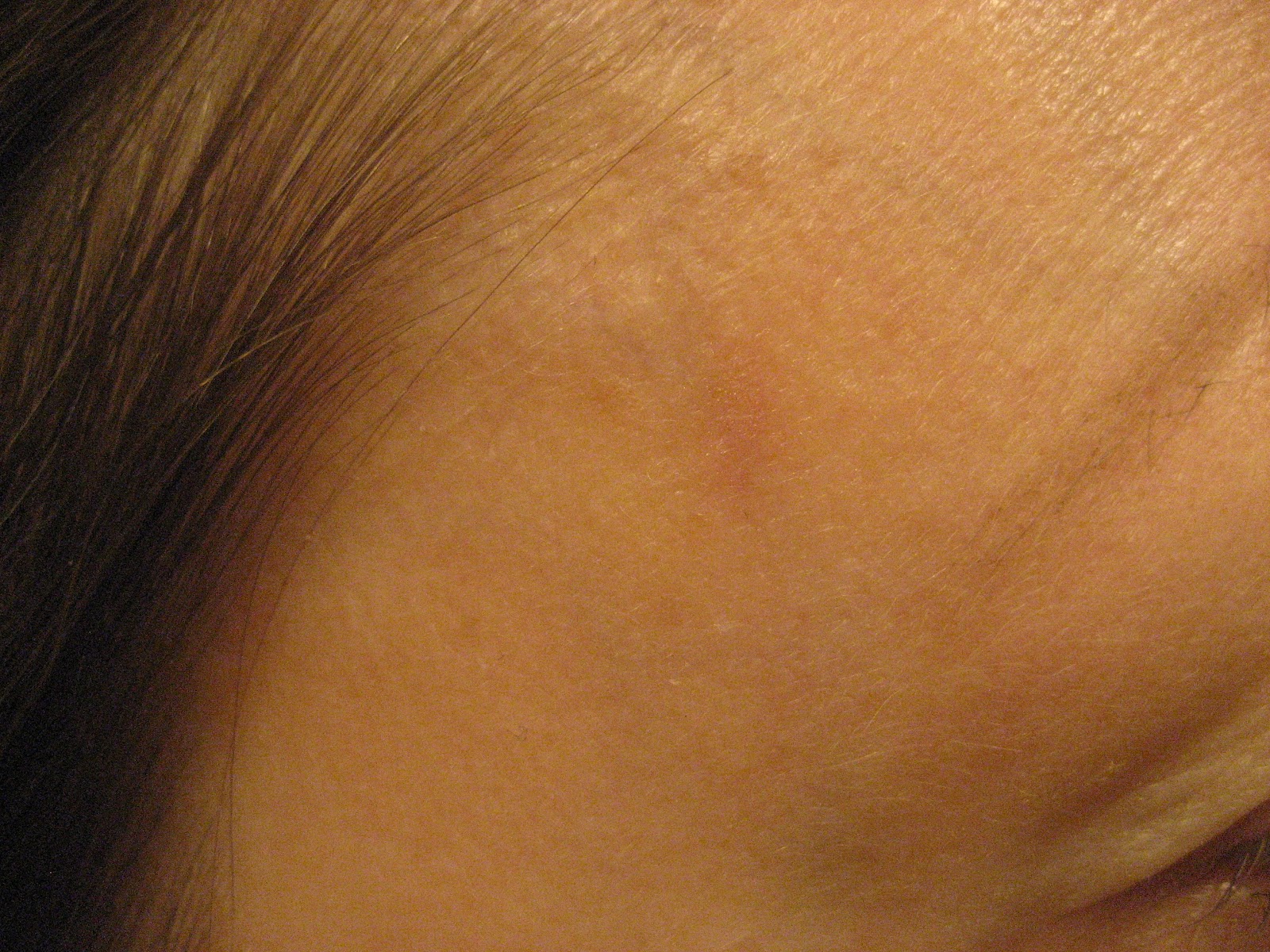 Chemical Peels for Acne and Anti Aging Facial Age Spot Finally gone!