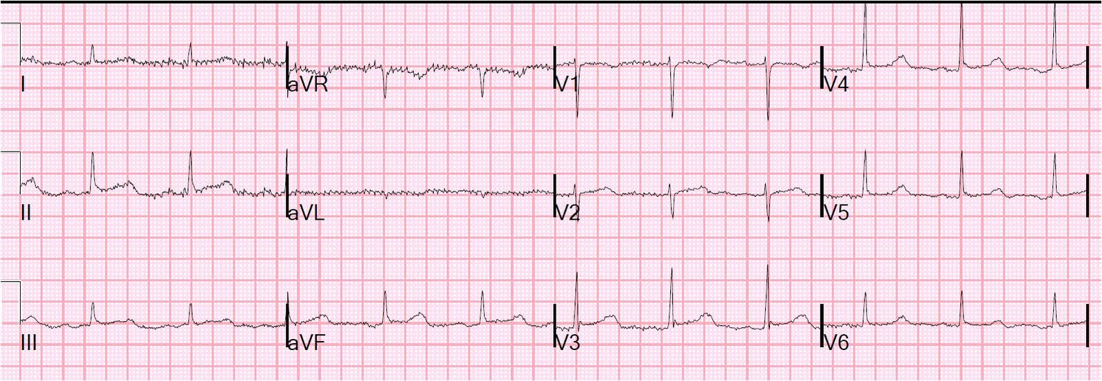 Hypothermia Ekg