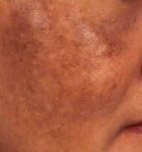 Chloasma During Pregnancy