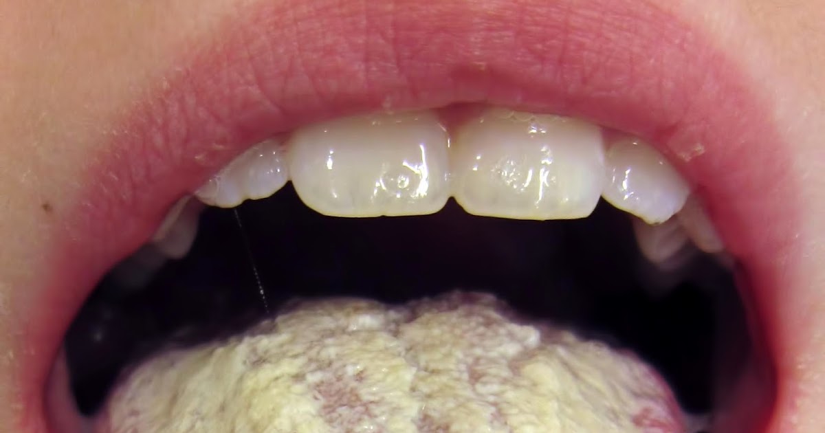 Be Well My Friends Oral Thrush/ White Tongue