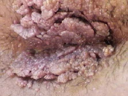Muncul Kutil Di Anus Muncul Kutil Di Anus