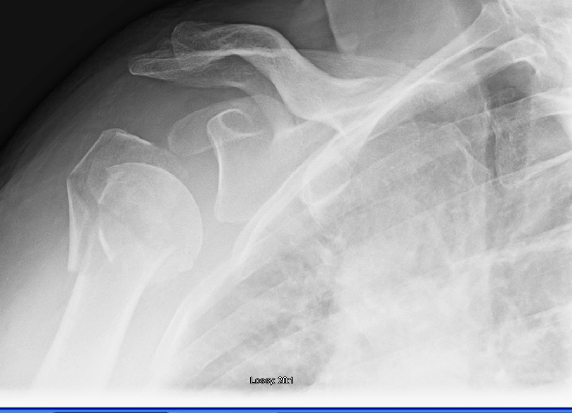 Shoulder and Elbow Surgery Humeral head split in the elderly Is