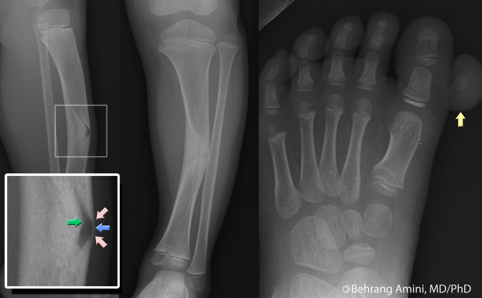 An unusual form of congenital anterolateral tibial angulation—the delta  tibia