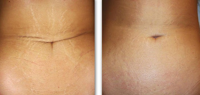 EL MEJOR REMEDIO NATURAL HECHO EN CASA PARA QUITAR LAS ESTRÍAS Y PARA HACER QUE SU PIEL SUAVE COMO EL TERCIOPELO EL-MEJOR-REMEDIO-NATURAL-HECHO-EN-CASA-PARA-QUITAR-LAS-ESTRÍAS-Y-PARA-HACER-QUE-SU-PIEL-SUAVE-COMO-EL-TERCIOPELO