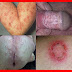 Cara Herbal Penyembuhan Herpes thumbnail