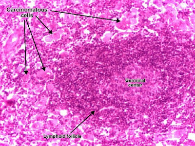 Lymph node with carcinoma metastasis : clusters of tumor cells, atypical, with carcinomatous character.
