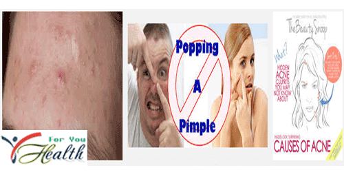 Causes of Acne Acne
