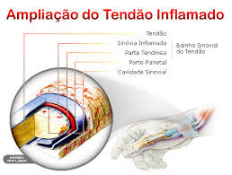 Inflamação nos tendões: entenda as causas, quais os sintomas e formas de tratamento rápido e prático. Inflamação dos Tendões    Dor no pulso, no ombro, no joelho? Cuidado, você pode estar sofrendo de algum tipo de tendinopatia ou inflamação do tendão (tecido fibroso pelo qual um músculo se prende a um osso). Conheça melhor as características desse problema e como se livrar dele.