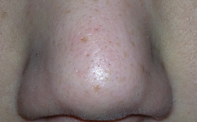 afternose3.jpg