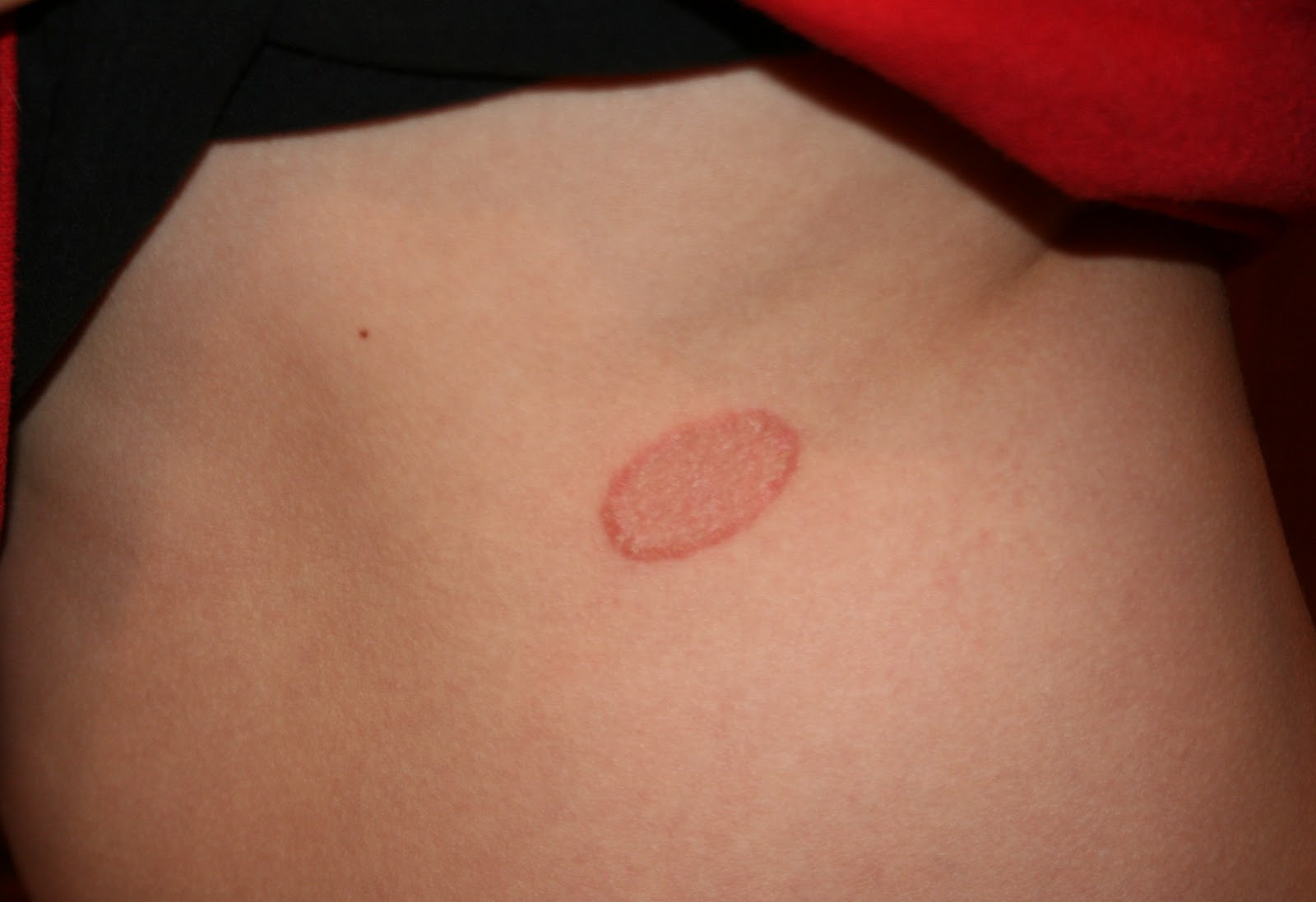 can you treat ringworm with terbinafine
