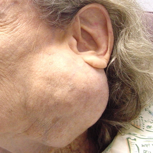 Do adults have their adenoids removed