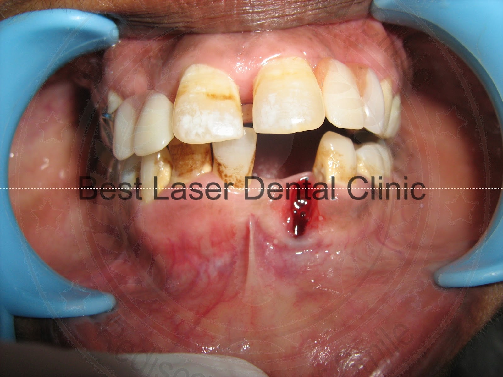 » Gallery 6Immediate Dental Implant placement in a periodontaly