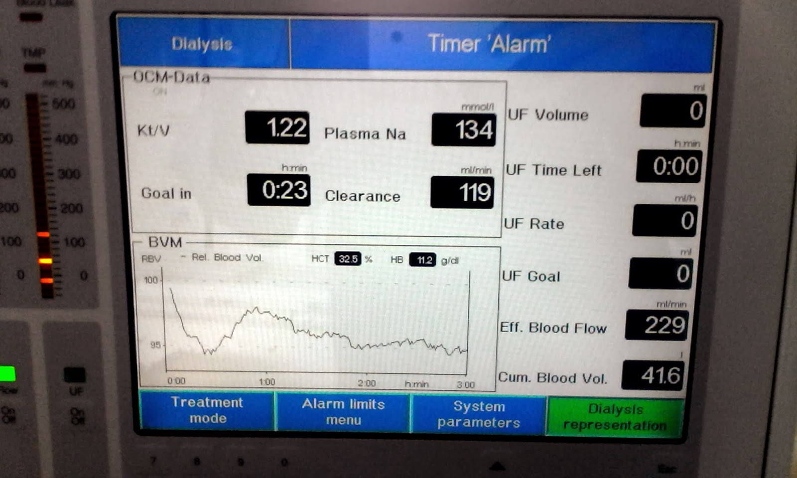 Dialysis Day Dialysis Blood Volume Monitor (BVM) Lie Detector