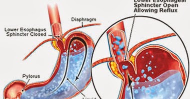 Ciri-ciri Umum Penyakit Maag ~ Obat penyakit, ciri-ciri, gejala dan