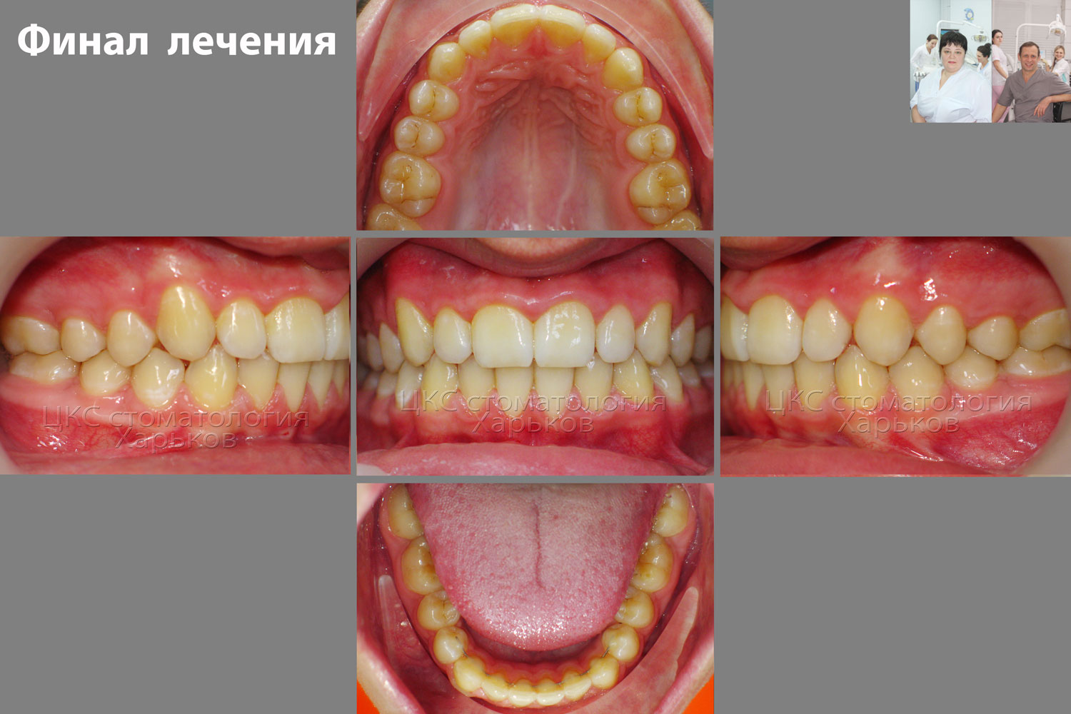Как сделать брекет для зубов Как сделать брекет для зубов