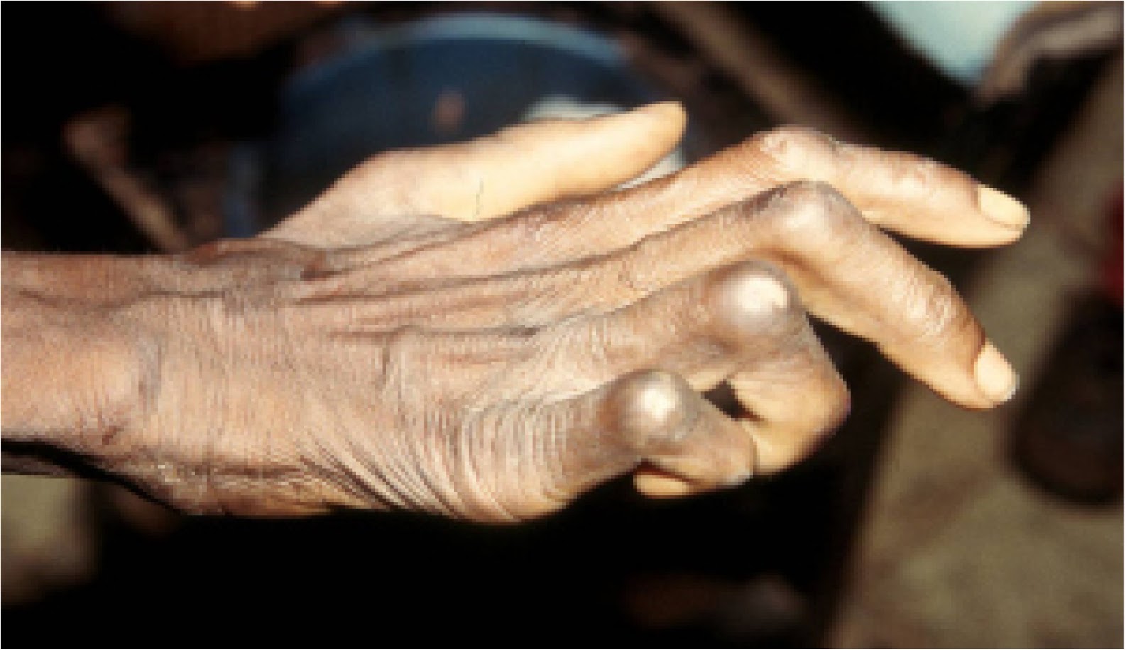 la enfermedad de lepra historia de la lepra