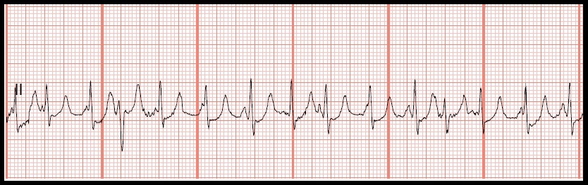 Float Nurse: EKG Rhyth...