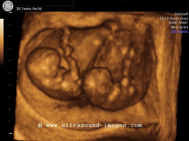 cochinblogs: 3D ultrasound images gallery from 5 weeks ...