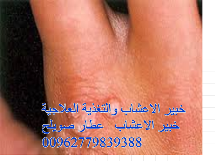 الثاليل التناسلية في الفم والحلق خطرها وكيفيه علاجها