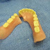 Causas da quebra de dentes e próteses (segundo os pacientes)