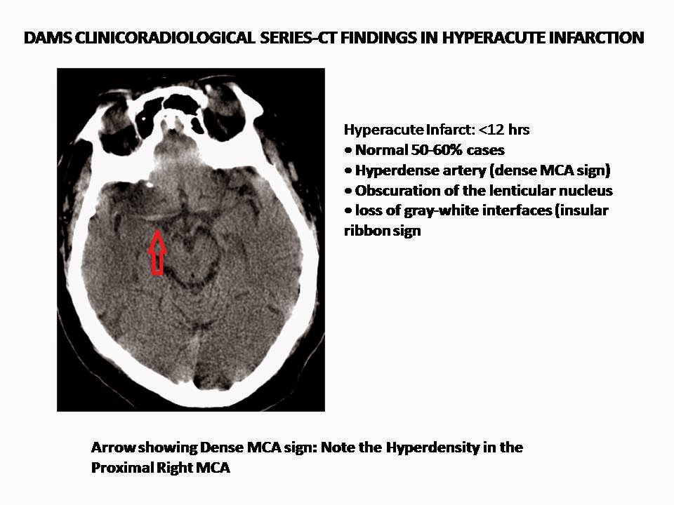 What Does Remote Infarct Mean On Mri at Byron Ridgway blog