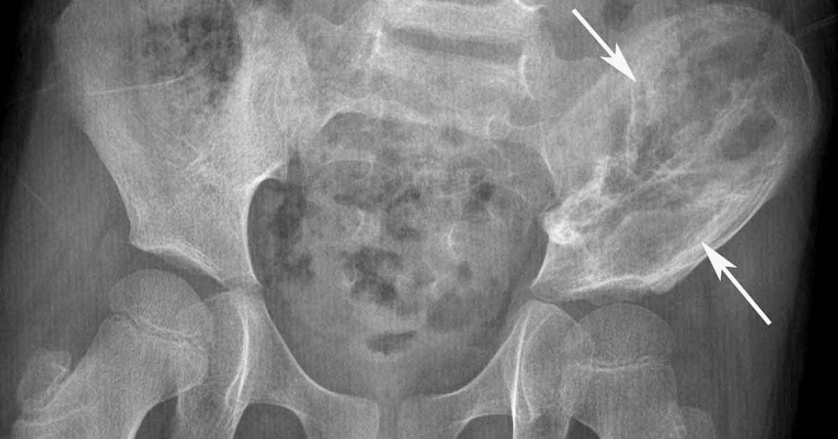 RiT radiology Pelvic Ewing's