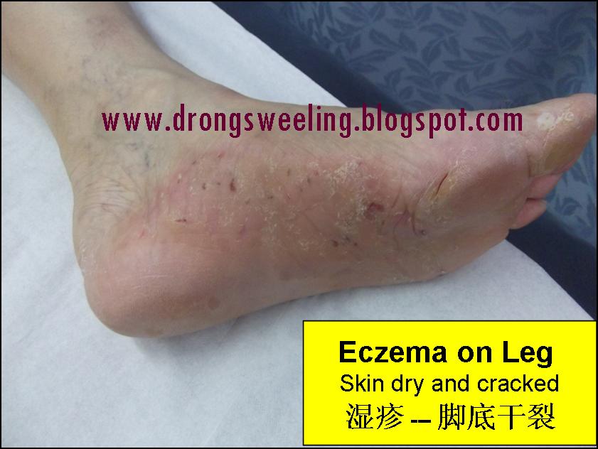 TCM News TCM Eczema Treatment for Eczema, Psoriasis, Best TCM Doctor