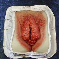 kutil kelamin di vagina kutil kelamin di vagina