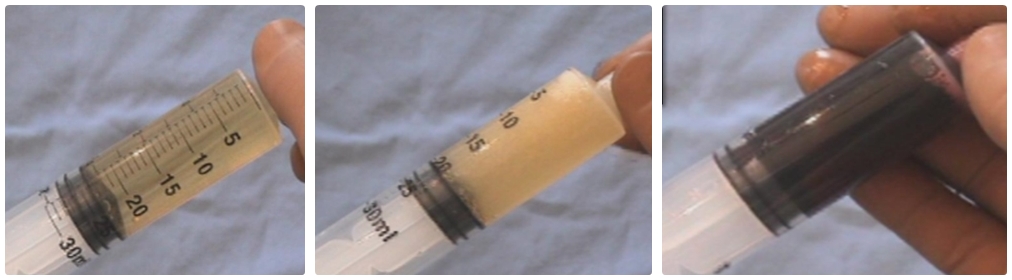 Bastonetes baixos no exame de sangue