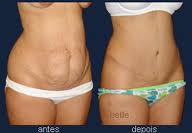 Abdominoplastia Fotos Antes e Depois Abdominoplastia Fotos Antes e Depois