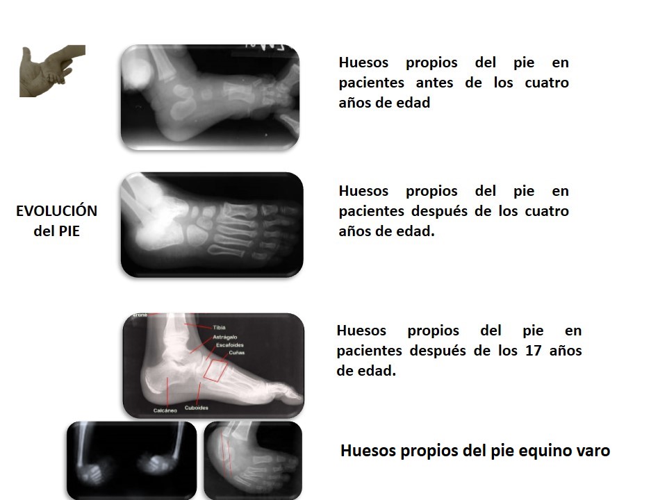 SIN CIRUGÍAS en LÍNEA Pie Equino Varo Vs Compresión Intrauterina.