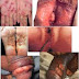 Cara Mengatasi Penis Bentol thumbnail