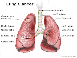 Lung Cancer Lung Cancer