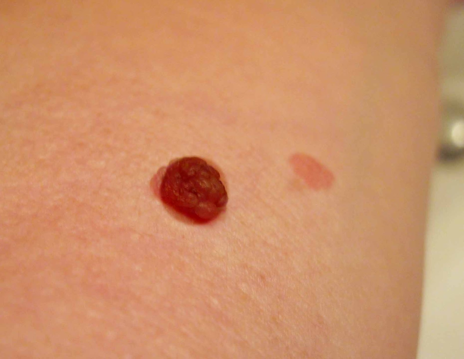 Raised Red Patch On Skin